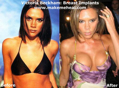 victoria-beckham-breast-implants-3.jpg