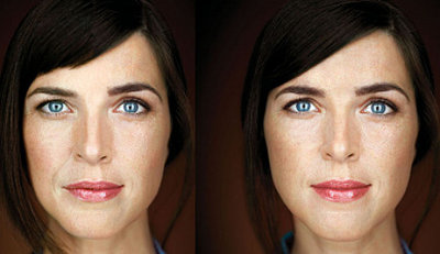 evolence-450pxw-before-and-12-mos-after-ortho-dermatologics.jpg