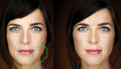 evolence-450pxw-before-and-12-mos-after-ortho-dermatologics-1.JPG