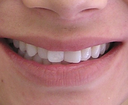 11-smile-before.jpg